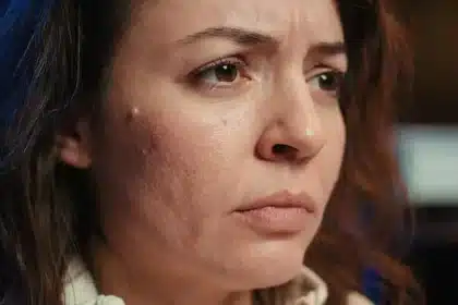 morpheus8 ruined my skin